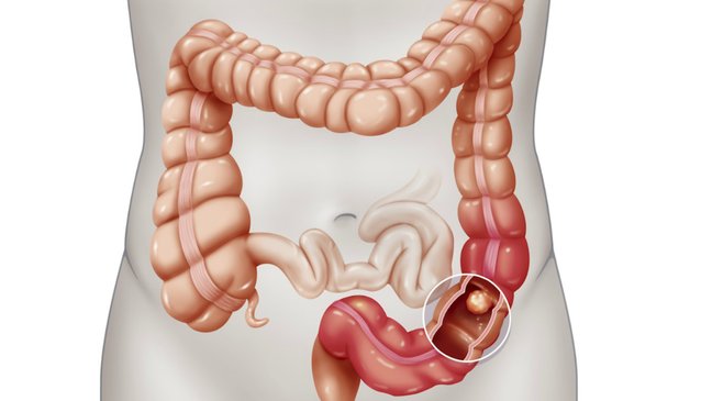 Câncer colorretal: sintomas são sangue nas fezes, cólicas e até fadiga